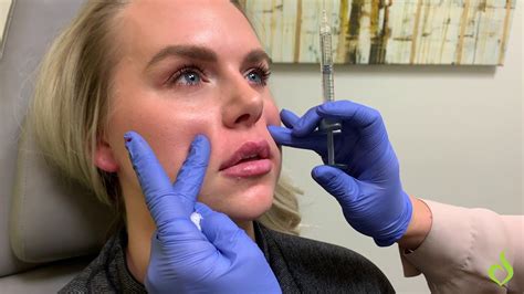 Lip Filler Consultation Discounts: Exploring Limited-Time Offers