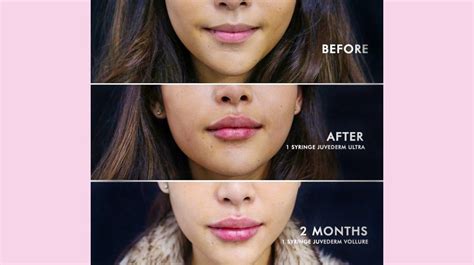 Insurance Coverage for Lip Fillers: How to Save Unexpectedly