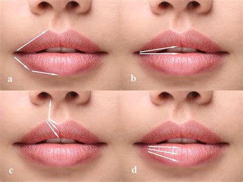 Budget-Friendly Lip Filler Techniques: What You Need to Know