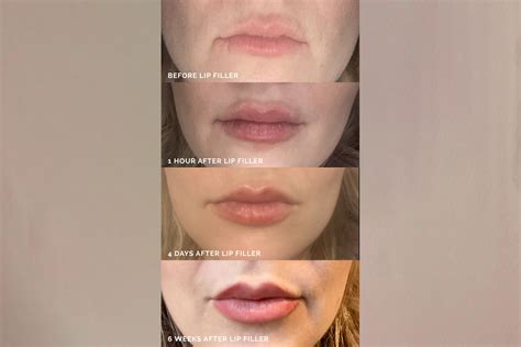 The Affordable Aesthetic: How to Get the Most Out of Lip Filler on a Budget