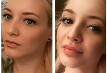 Budget Beauty: Lip Filler Tips for a Gorgeous Yet Affordable Transformation