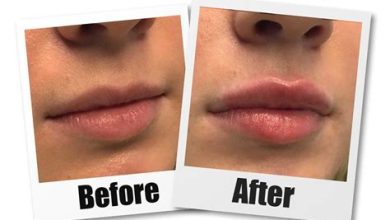 Deciphering Lip Filler Costs: A Deep Dive into Different Types
