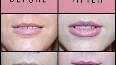 Expert Advice at a Price: Understanding Lip Filler Consultation Costs