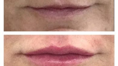 A Glimpse of Glamour: Exploring High-End Lip Filler Treatments