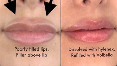 The Luxury of Lip Fillers: Indulging in High-End Enhancements
