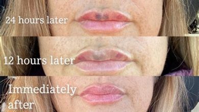 Beauty Bargains: How to Save Money on Lip Filler Procedures